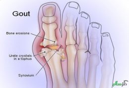 دانستنی های پزشکی مهم در مورد نقرس