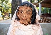 زنی با چهره ای مملو از تومورهای ریز