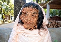 زنی با چهره ای مملو از تومورهای ریز