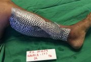 پزشکان با پوست ماهی تیلاپیا توانستند سوختگی را درمان کنند