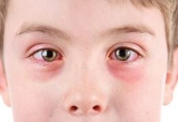 8 علت اصلی قرمز شدن چشم و راه های درمان آن