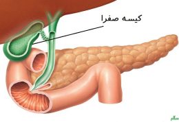 با مصرف این غذاها از ابتلا به سنگ صفرا پیشگیری نمایید