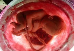 آیا طب سنتی جنسیت جنین را مشخص میکند؟