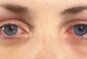 درمان عفونت های چشمی چقدر طول میکشد؟چه علائمی دارند؟