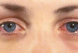 درمان عفونت های چشمی چقدر طول میکشد؟چه علائمی دارند؟