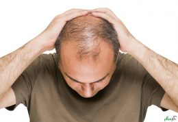 6 دلیل اصلی ریزش مو که سبب کچلی می شوند