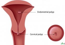 پولیپ رحمی چیست و راه درمانش چیست؟