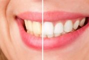 استفاده از روش های خانگی برای سفید کردن دندان،ممنوع