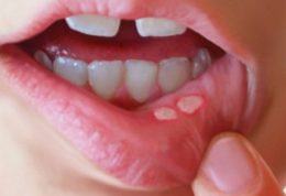 موثر ترین درمان برای آفت دهان