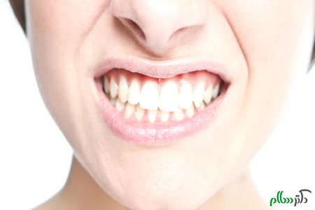 دندان قروچه چیست و راه های درمان آن کدامند؟