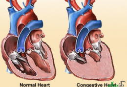 نارسایی احتقانی قلبی و نکات تغذیه ای مربوط به آن قسمت اول