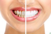 راهکارهای موثر برای سفید ترشدن دندان ها