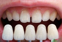 عمر مفید روکش های دندان چند سال است؟