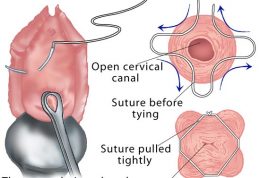توضیحات پزشکی در مورد عمل سرکلاژ