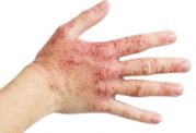 درماتیت دست چیست و چگونه درمان میشود؟