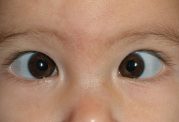 روش های بررسی انحراف چشم