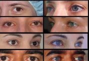 جراحی تغییر رنگ چشم خطر نابینایی و تخلیه چشم به همراه دارد