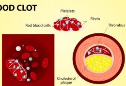 مقابله با ترومبوز در رگ های خونی