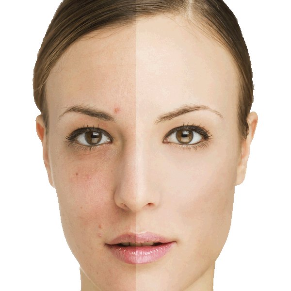 Image result for ‫از بین بردن لک های پوستی‬‎