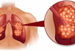 سرفه های خطرناک و سرطان ریه