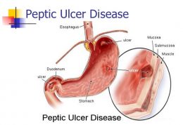 اولسر پپتیک و رژیم غذایی آن