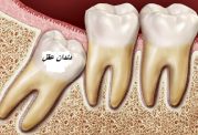 مخاطرات دندان عقل