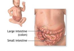 درمان انسداد روده در سنین پایین