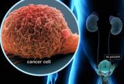 عوامل خطر سرطان مثانه