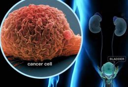 عوامل خطر سرطان مثانه