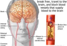 مقابله و پیشگیری از سکته مغزی