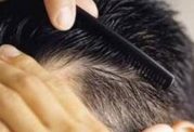 تاثیر ژنتیک بر ریزش مو در مردان