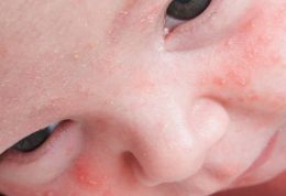 آکنه های ریز روی پوست نوزادان