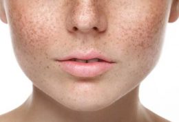 راه حل خانگی برای درمان لک های قهوه ای پوست