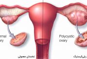 6 نشانه مبتلا بودن به سندروم تخمدان پلی کیستیک (PCOS)