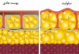 شکل گرفتن سلولیت در بخش هایی خاص از بدن،چرا؟