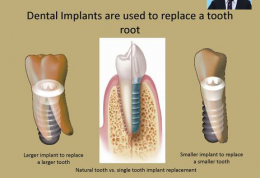 ایمپلنت؛ تنها جایگزین دندان از دست رفته