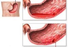 خطرات خونریزی گوارشی برای بدن