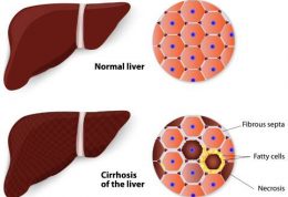 انواع کبد چرب الکلی و غیرالکلی