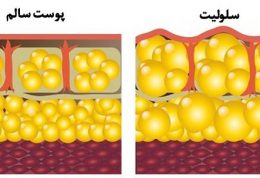 با این حرکات ورزشی سلولیت را درمان کنید