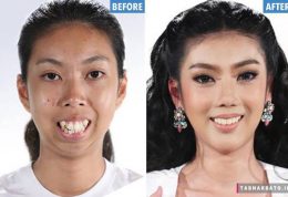 جراحی چانه باعث زیبایی منحصر به فرد دختر تایلندی شد