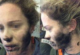 سوختگی صورت دختر جوان در اثر انفجار باتری