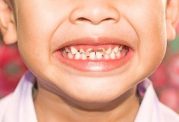 میزان شیوع پوسیدگی دندان در ایران