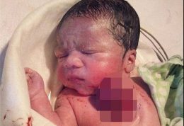 تولد نوزادی که قلبش بیرون از سینه می‌تپد