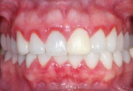 آبسه مغزی میتواند علتی مانند عفونت دندان داشته باشد