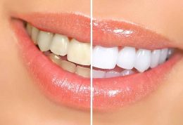 افزایش سفیدی دندان با روش های ساده