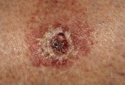 5 نشانه سرطان پوست را بشناسید