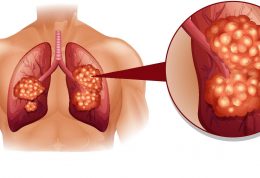 سرطان ریه در غیر سیگاری ها به چه علت است؟