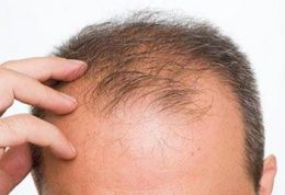 داروهای ضد ریزش مو خطر ناتوانی جنسی را افزایش می دهند