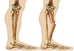دستورالعملی برای درمان خانگی شکستگی استخوان