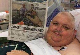 تومور 60 کیلویی با موفقیت از بدن بیمار خارج شد